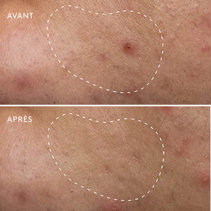 Deep Breakout Liquid Patch Anti-Imperfections