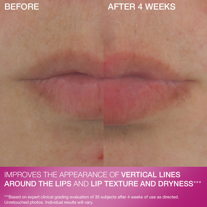 Double Fix® for Lips Plumping & Vertical Line Treatment